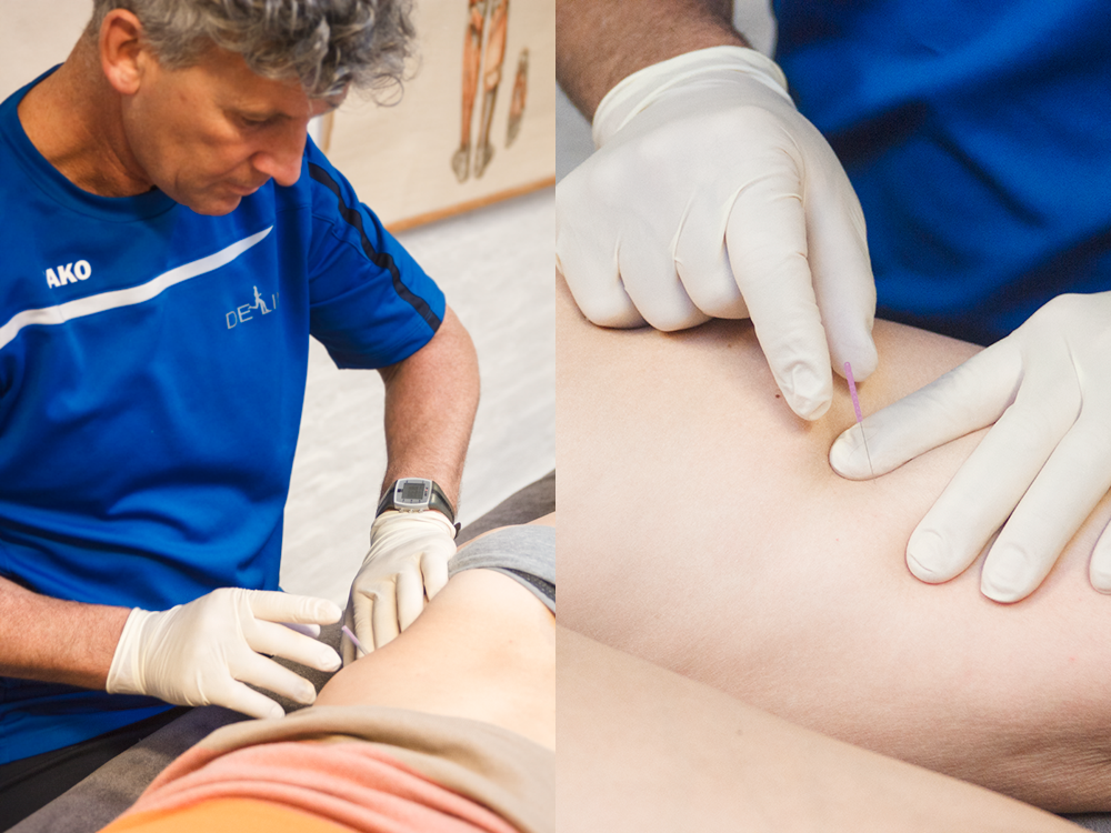 Dry Needling Den Helder